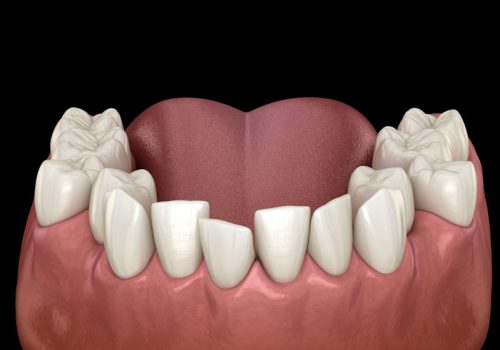 Medical image of crooked teeth