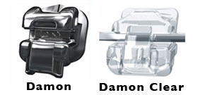 Detailed product photos of two types of Damon braces brackets, including Damon Clear.