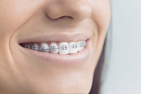 Young woman with brackets