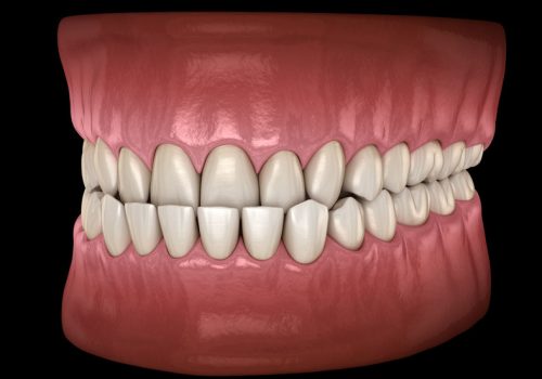 Medical image of an underbite